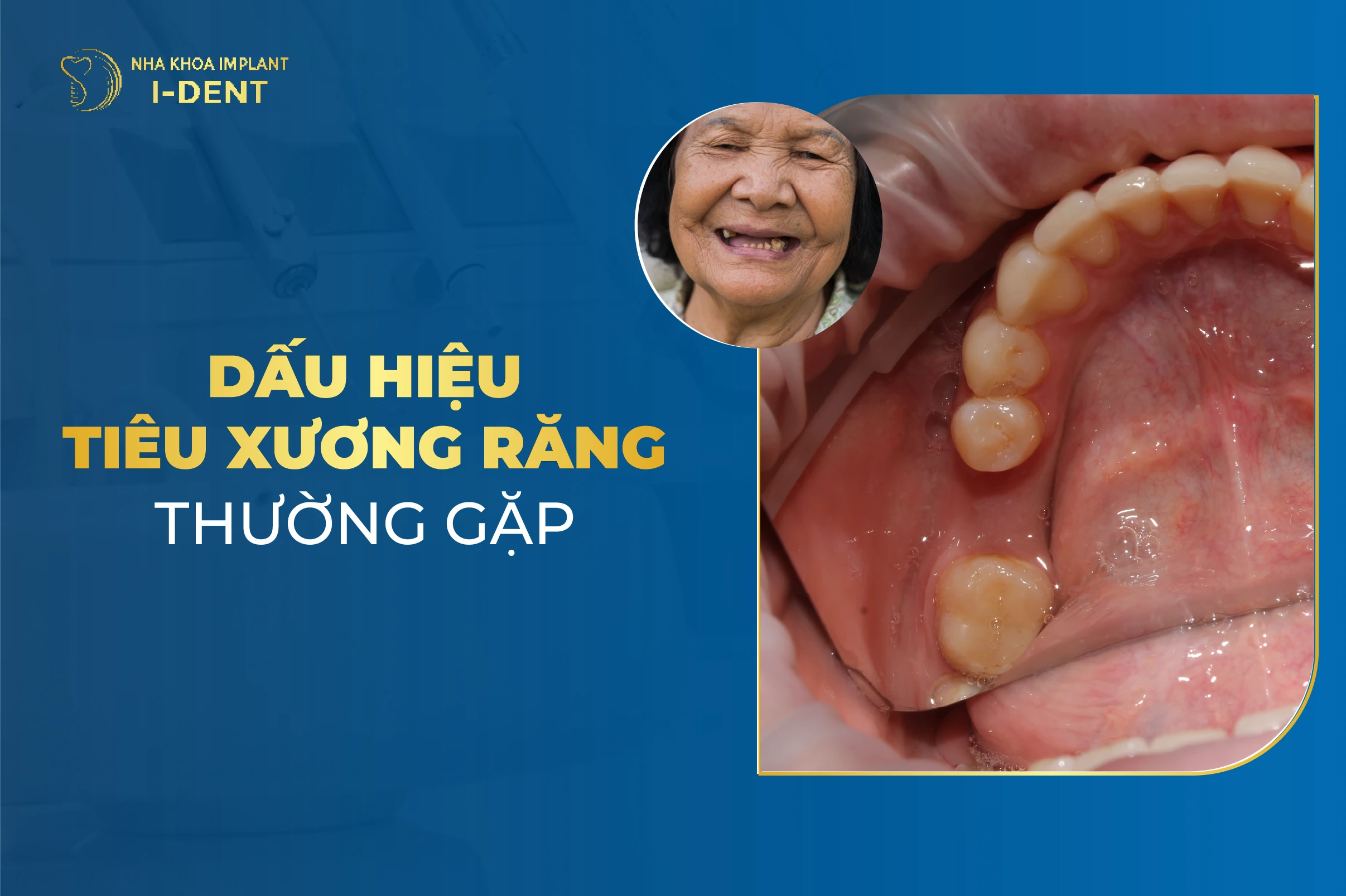 Nhận Biết 7 Dấu Hiệu Tiêu Xương Răng Thường Gặp