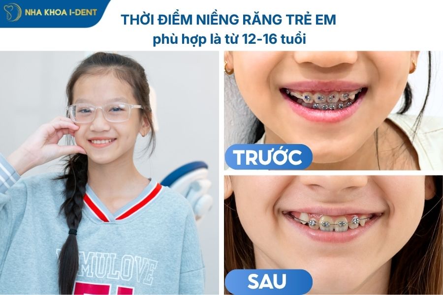 niềng răng trẻ em giá bao nhiêu