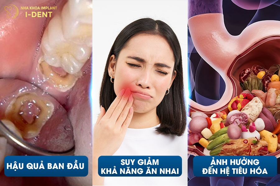 Một số hậu quả ban đầu khi mất răng số 7 hàm trên