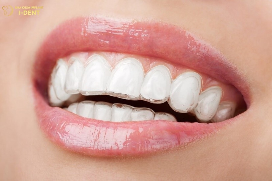 niềng răng invisalign có tốt không