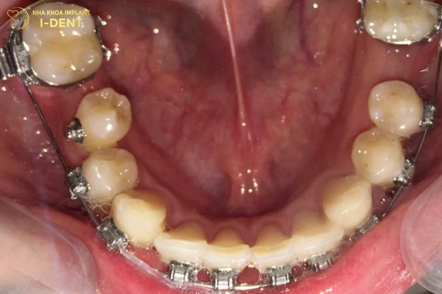 mất 2 răng số 6 có niềng được không