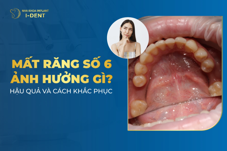 Mất Răng Số 6 Ảnh Hưởng Gì? Hậu Quả Và Cách Khắc Phục