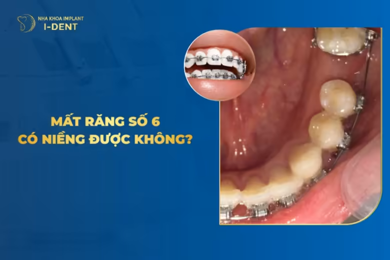 mất răng số 6 có niềng được không