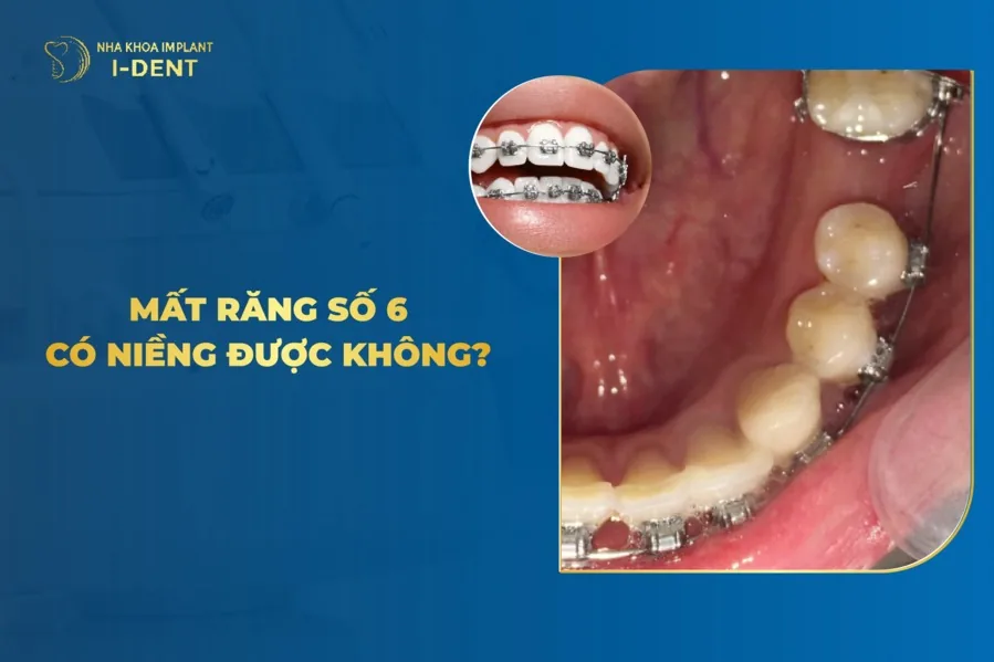mất răng số 6 có niềng được không