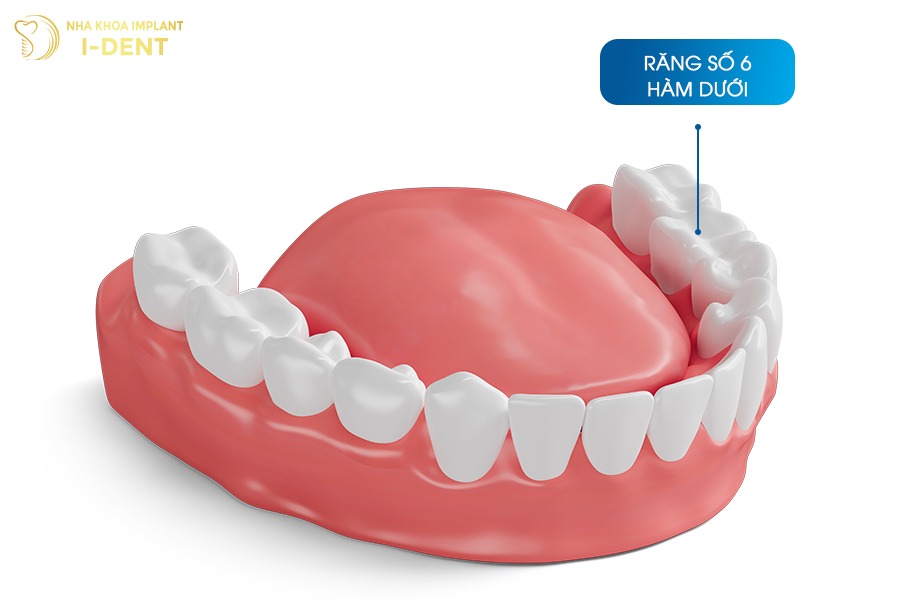 mất răng số 6 có niềng răng được không