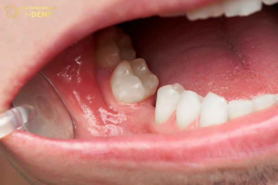 Mất răng số 6 khiến các răng kế cận nghiêng đổ gây sai lệch khớp cắn.