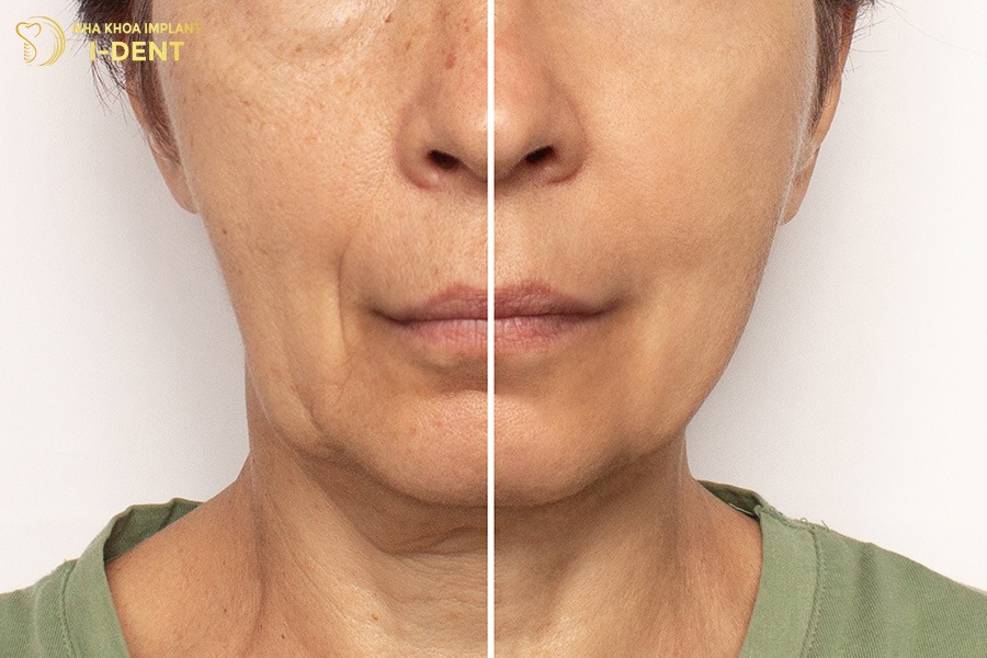 Mất răng số 6 khiến khuôn mặt hóp má trông già hơn tuổi thật.