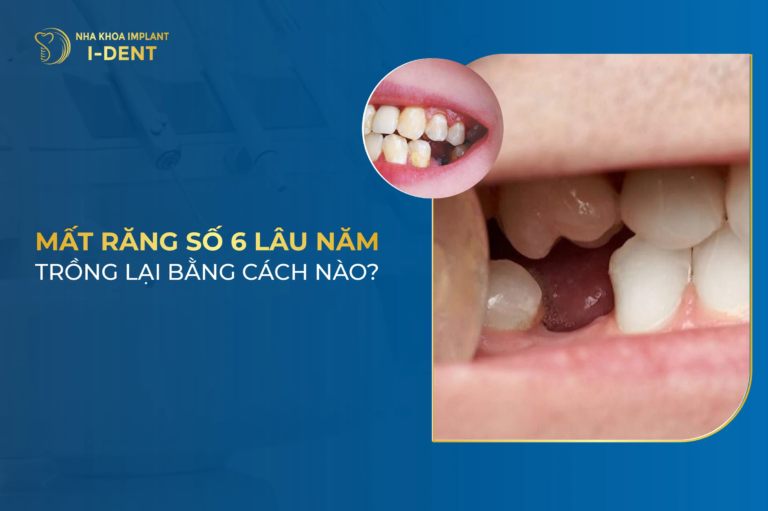 hậu quả khi mất răng số 6 lâu năm