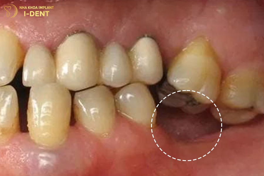 Sau khi mất răng số 6 thì xương hàm tại vị trí đó tiêu biến dần.