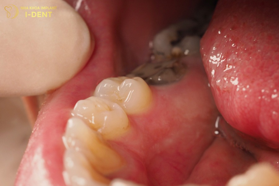 Mất răng số 6 lâu năm gây viêm nhiễm răng miệng.