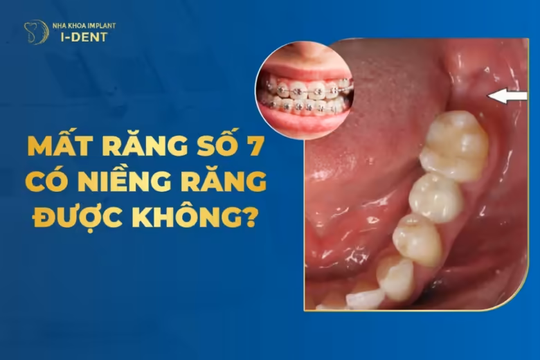mất răng số 7 có niềng răng được không