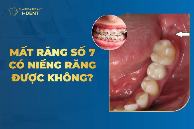 Mất Răng Số 7 Có Niềng Răng Được Không?