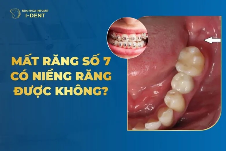 mất răng số 7 có niềng răng được không