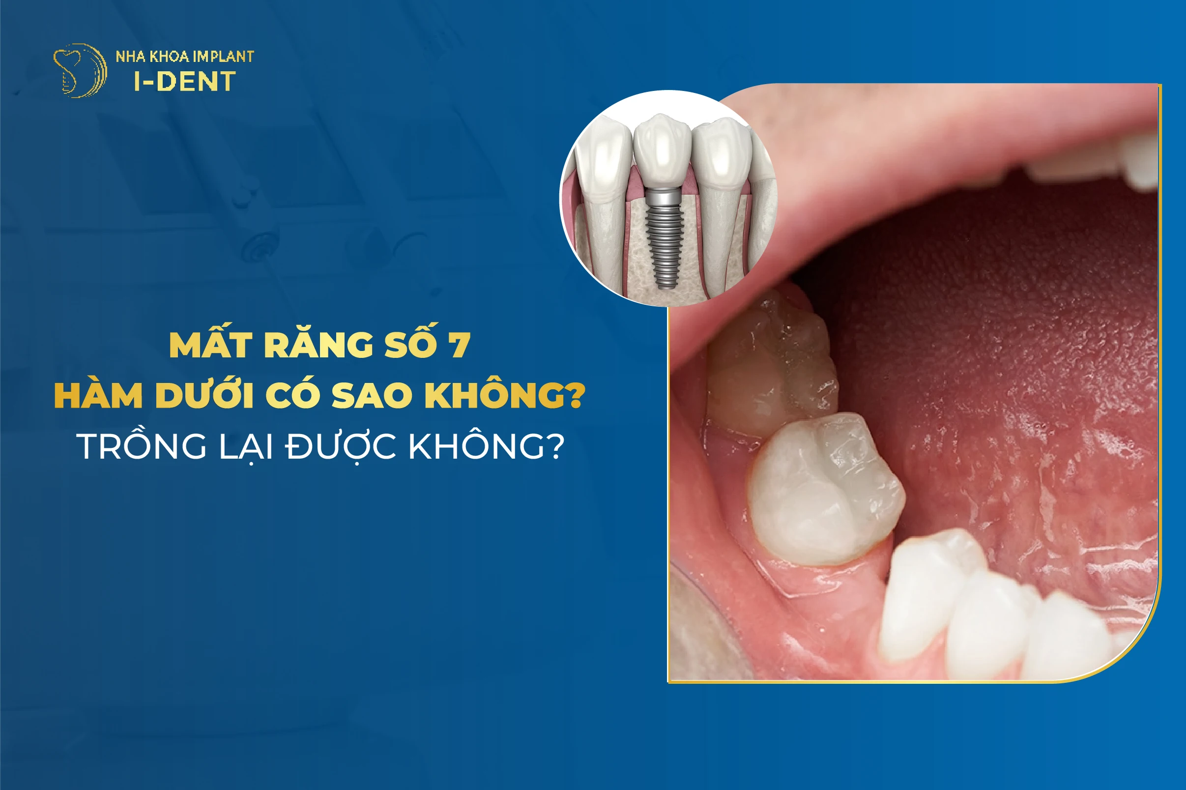 Mất răng số 7 hàm dưới có sao không? Trồng lại được không?