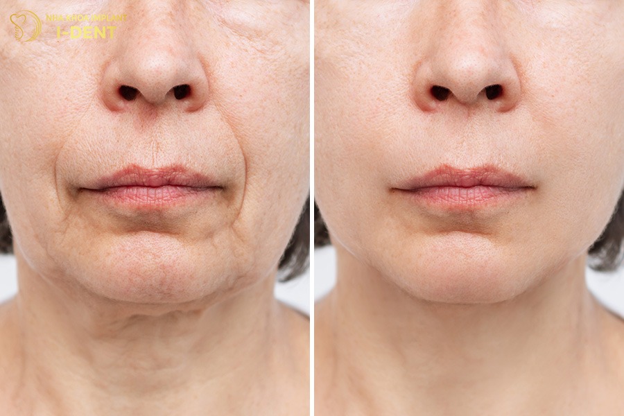 Mất răng lâu ngày khiến má hóp và khuôn mặt trông già hơn tuổi.