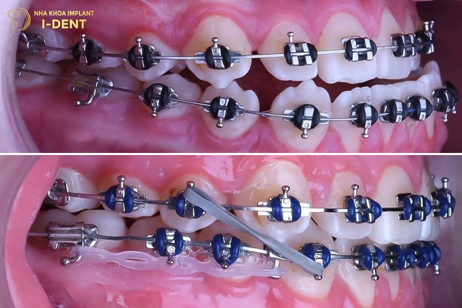 bị móm có niềng răng được không