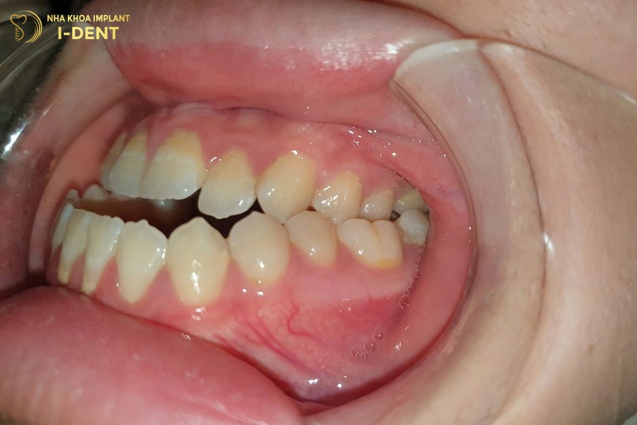 móm có niềng răng được không