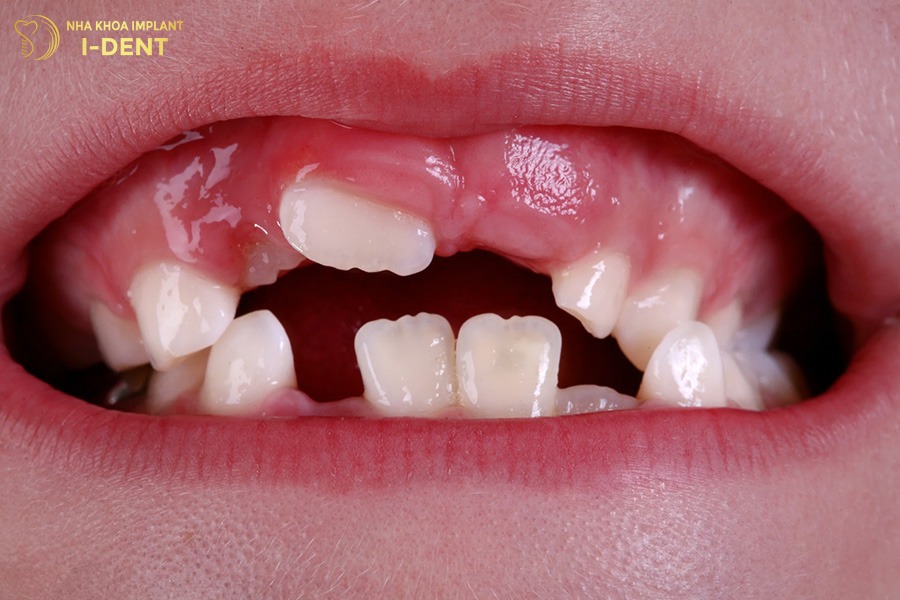 mức độ sai lệch của răng ở trẻ 6, 7, 8 tuổi