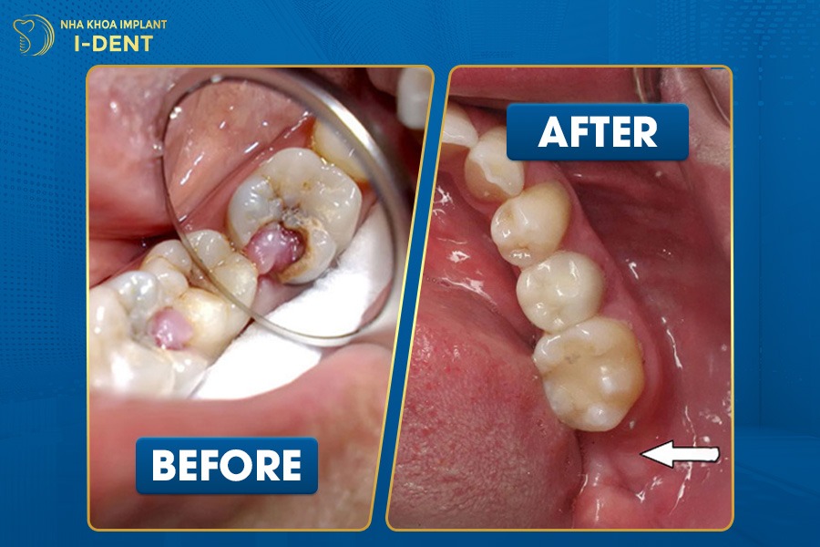 Vệ sinh răng miệng chưa đúng cách là nguyên dấn đến