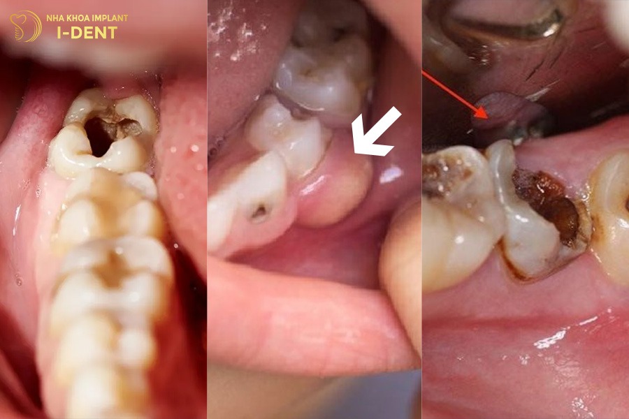 Nguyên nhân gây mất răng số 6 lâu năm.