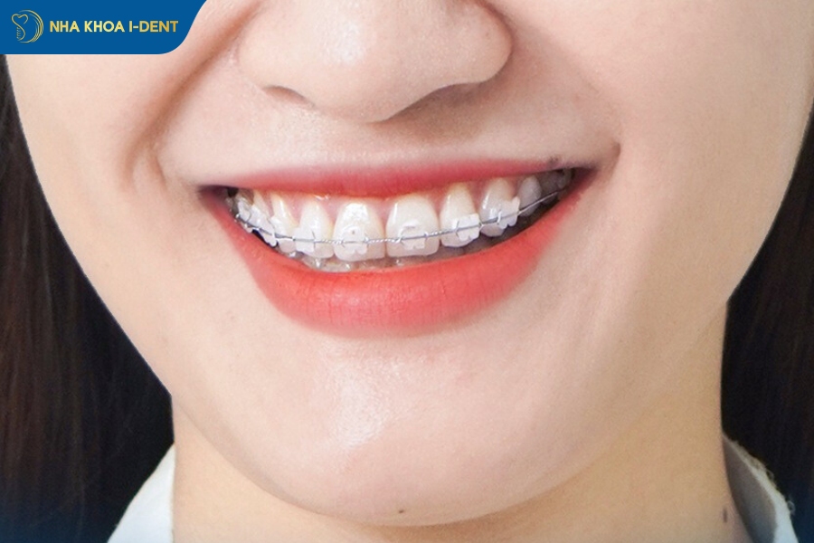 niềng răng mắc cài sứ