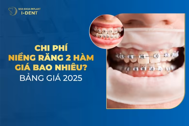 niềng răng bao nhiêu tiền 2 hàm