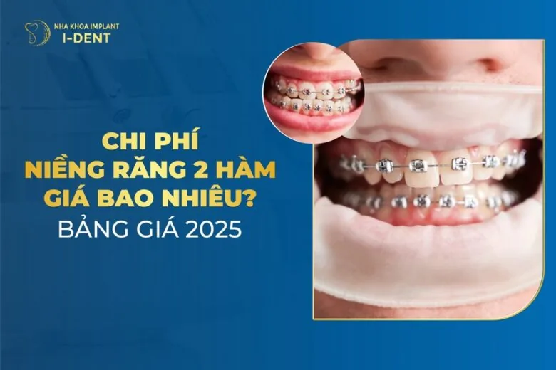 niềng răng bao nhiêu tiền 2 hàm