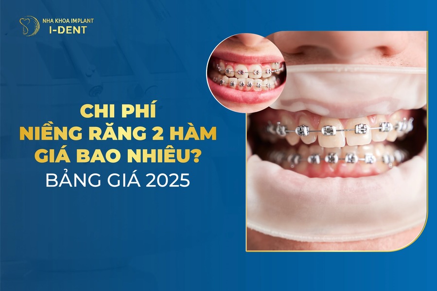 Chi Phí Niềng Răng 2 Hàm Giá Bao Nhiêu? Bảng Giá 2025