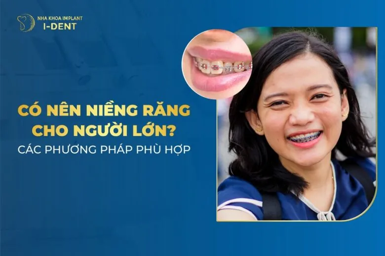 niềng răng cho người lớn