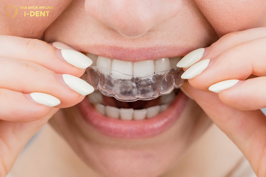 niềng răng invisalign bao lâu