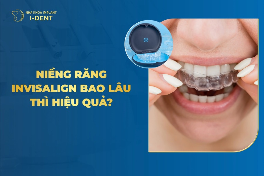 Niềng Răng Invisalign Bao Lâu Thì Hiệu Quả?