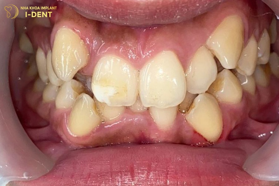 niềng răng invisalign mất bao lâu