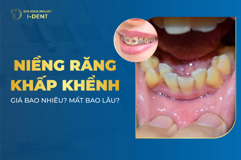 niềng răng khấp khểnh
