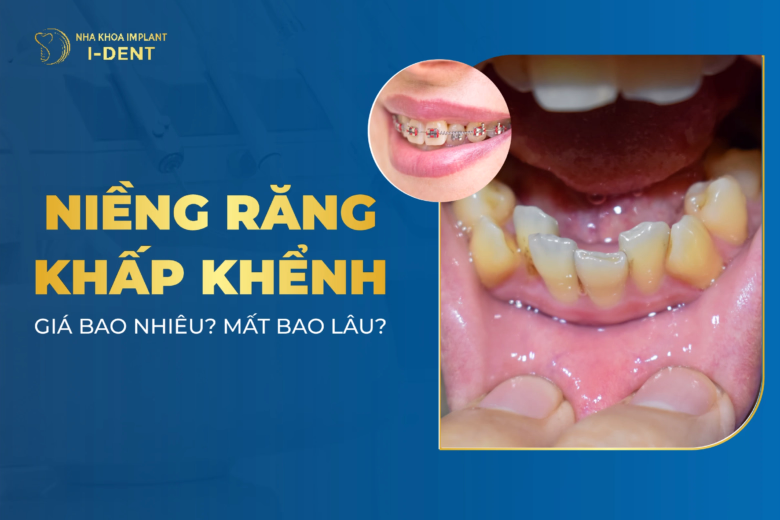 niềng răng khấp khểnh