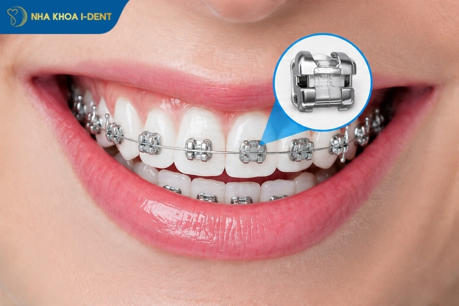 30 tuổi có niềng răng được không - Nha khoa I-Dent