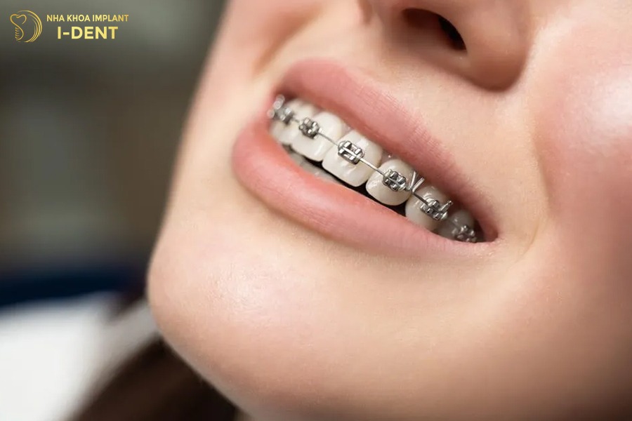 niềng răng mắc cài sắt