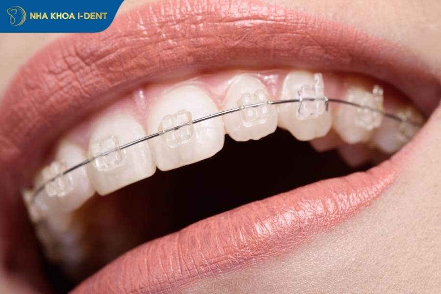 30 tuổi niềng răng mất bao lâu - Nha khoa I-Dent