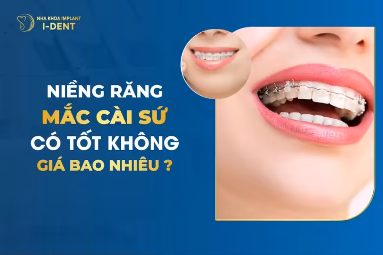 niềng răng mắc cài sứ