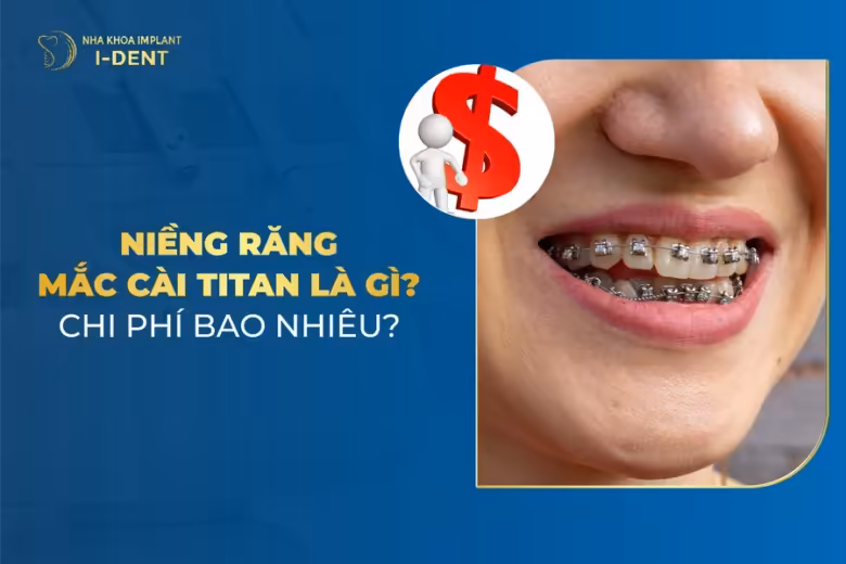 niềng răng mắc cài titan