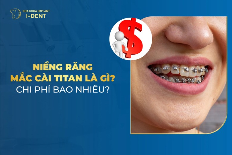 Niềng Răng Mắc Cài Titan Là Gì? Chi Phí Bao Nhiêu?