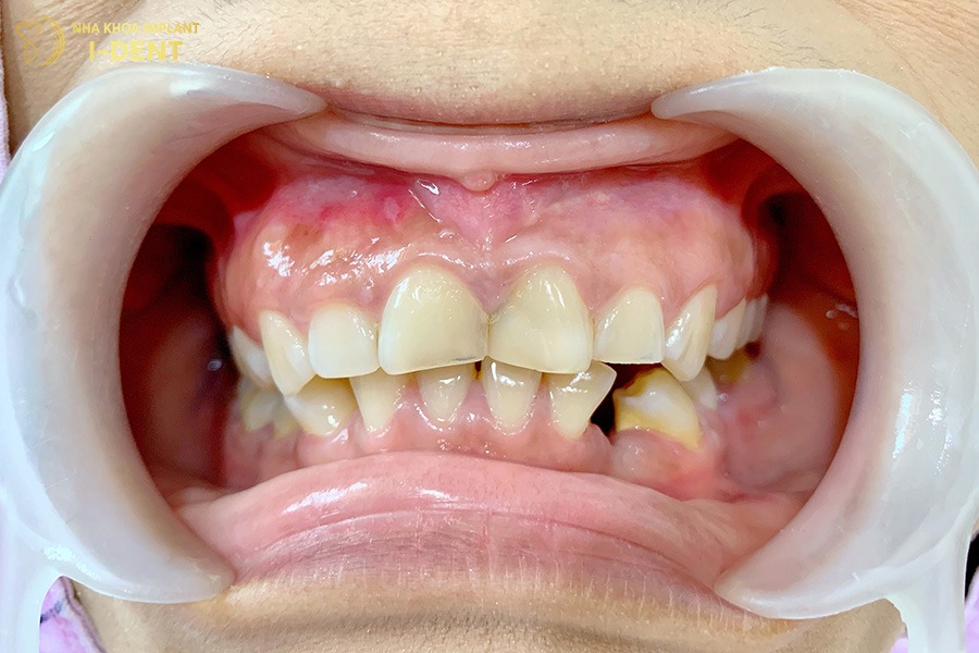 niềng răng mắc cài titan giá bao nhiêu