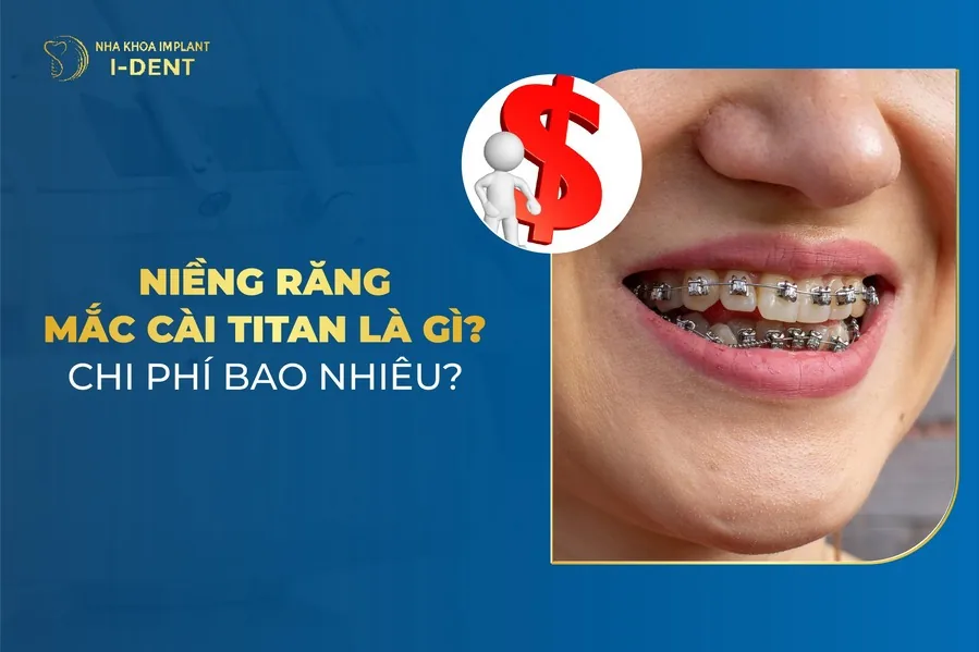 niềng răng mắc cài titan