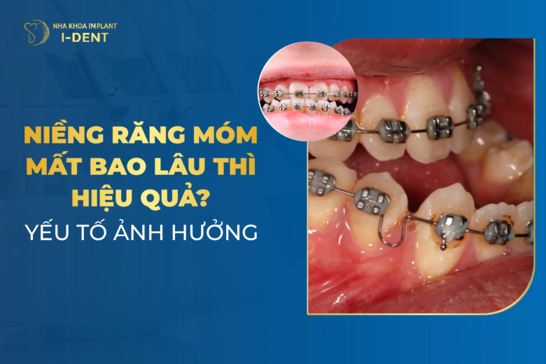 niềng răng móm mất bao lâu
