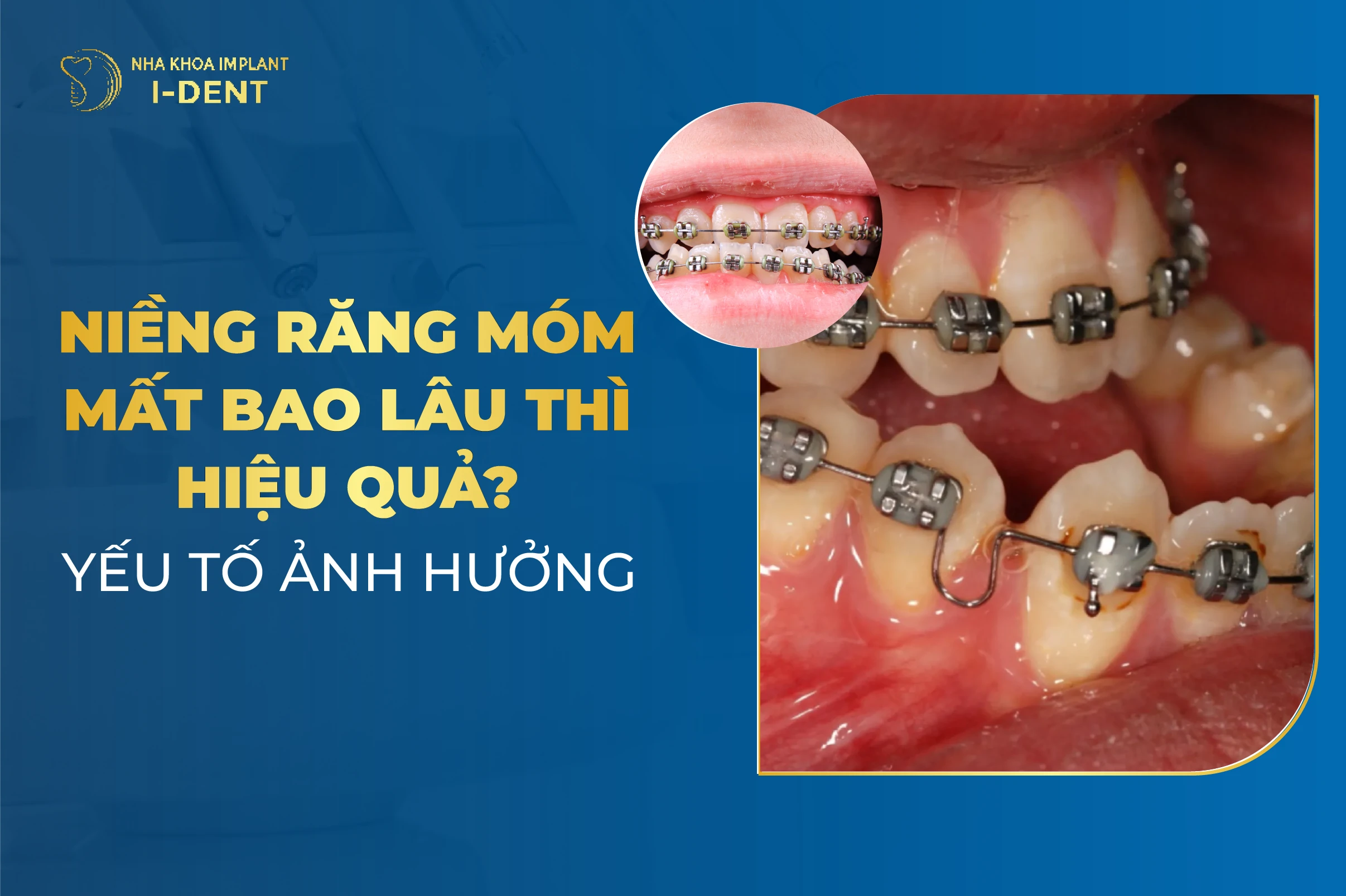 Niềng Răng Móm Trong Bao Lâu Thì Hết Móm? Yếu Tố Ảnh Hưởng