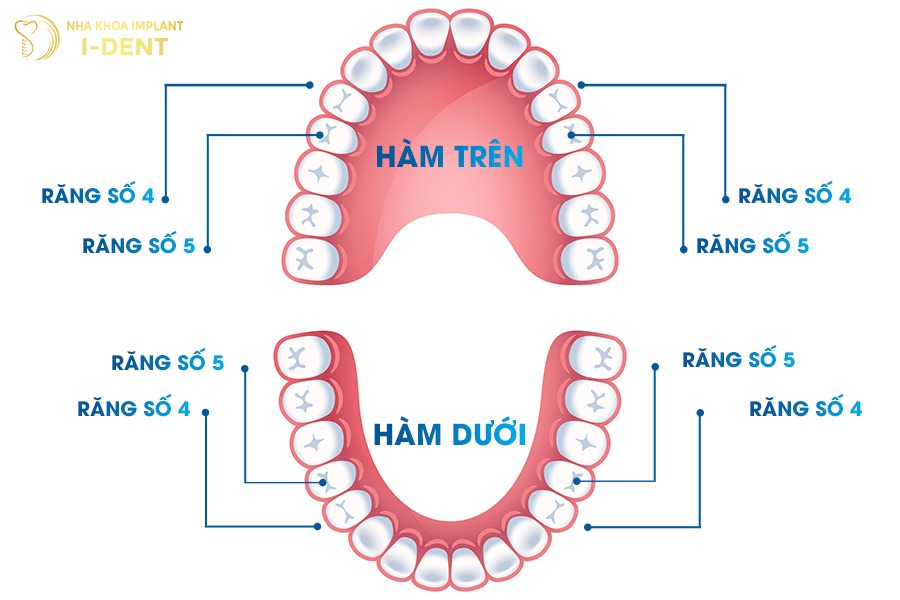 Niềng răng phải nhổ răng số 4