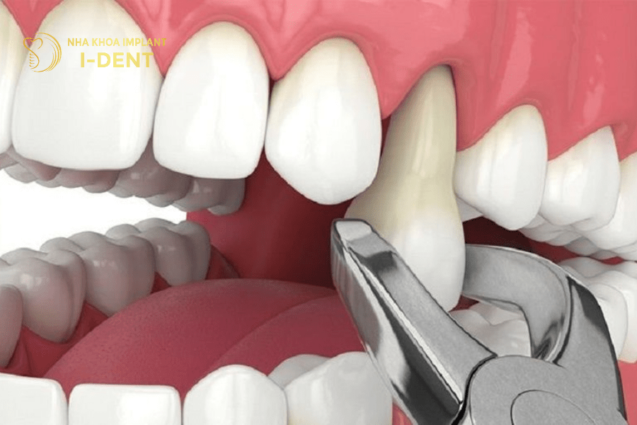 Nhổ 4 răng số 4 niềng răng là nhổ răng cối nhỏ nhất trên cung hàm.