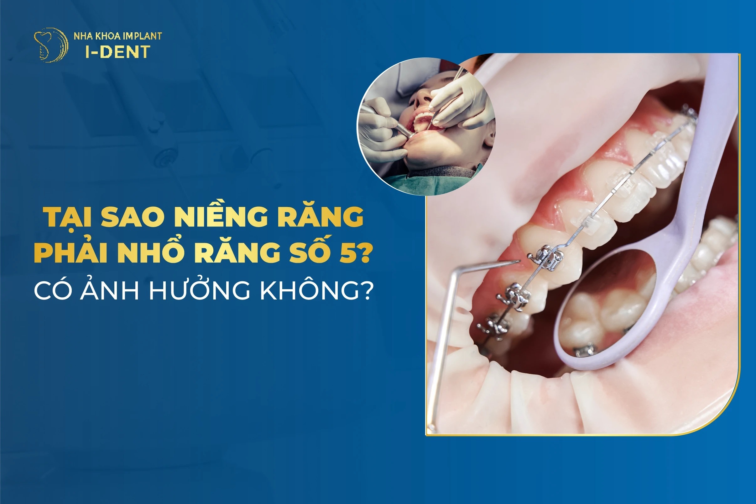Tại Sao Niềng Răng Phải Nhổ Răng Số 5? Có Ảnh Hưởng Gì Không?