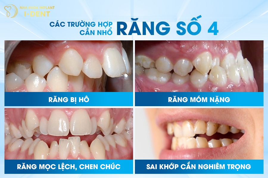 Những trường hợp niềng răng phải nhổ răng số 4
