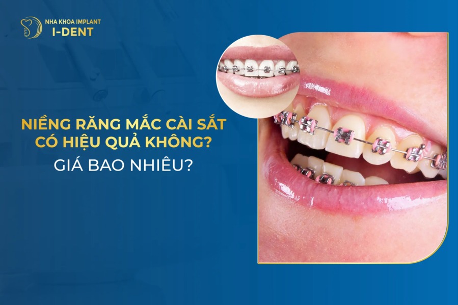 Niềng Răng Mắc Cài Sắt Có Hiệu Quả Không? Giá Bao Nhiêu?