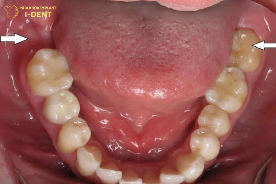 mất răng số 7 hàm dưới có niềng răng được không